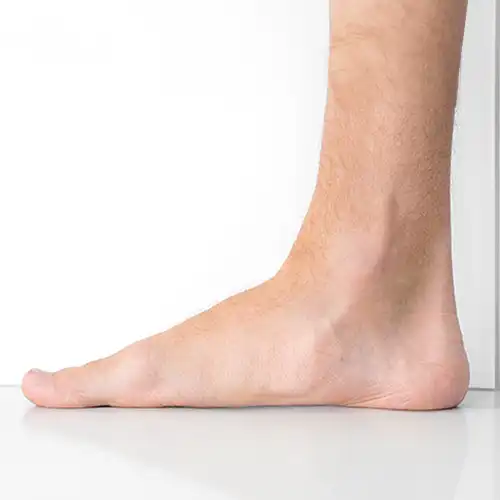 Flat Feet and High Arch Solutions - Foot Harmony Adelaide